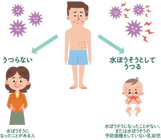 帯状疱疹は水ぼうそうになったことがある人にはうつらないが、水ぼうそうになったことのない、もしくは水ぼうそうの予防接種をしていない乳幼児には水ぼうそうとしてうつす可能性がある