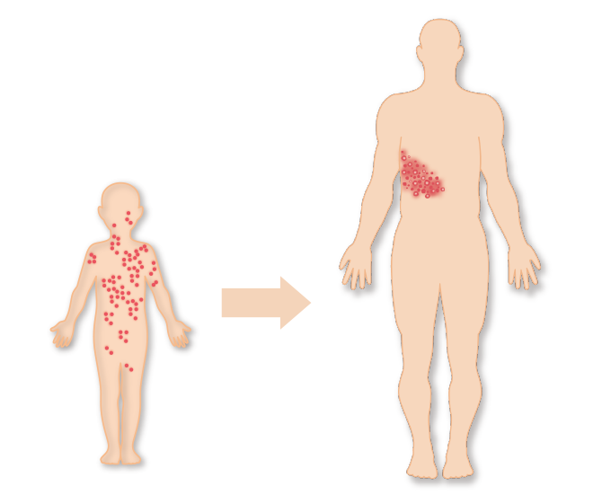 水ぼうそうが治った後も体内に潜んでいたウイルスが、帯状疱疹として発症します