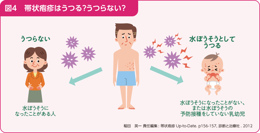 図4、帯状疱疹はうつる?うつらない?