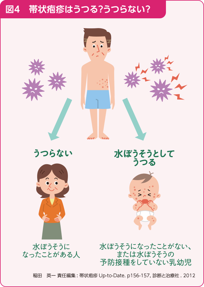 図4、帯状疱疹はうつる？うつらない？