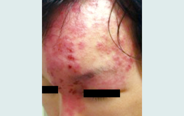 目の合併症のリスクが高い帯状疱疹の写真