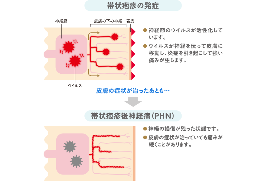 帯状疱疹後神経痛（PHN）では、神経の損傷により、皮膚症状が治った後も痛みが残ります