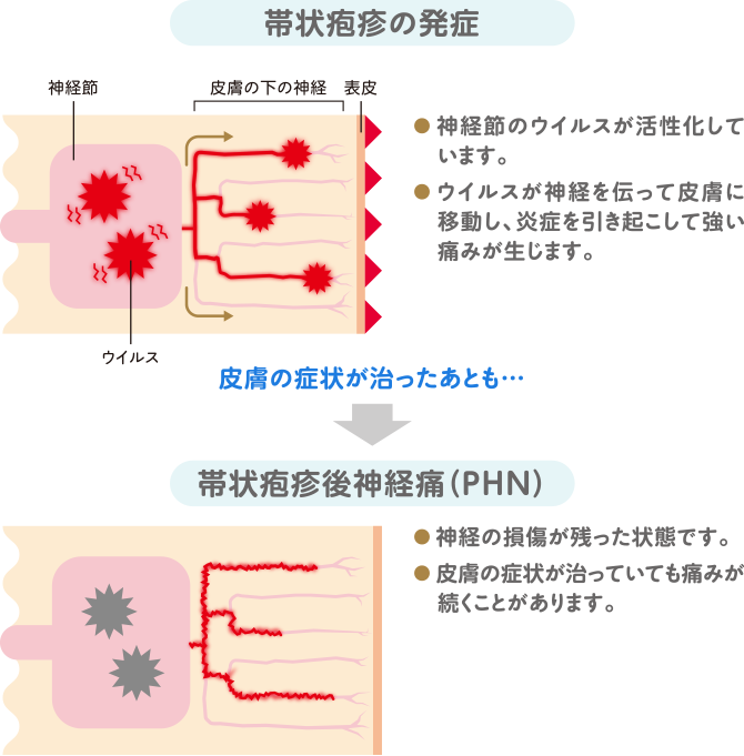 帯状疱疹後神経痛（PHN）では、神経の損傷により、皮膚症状が治った後も痛みが残ります